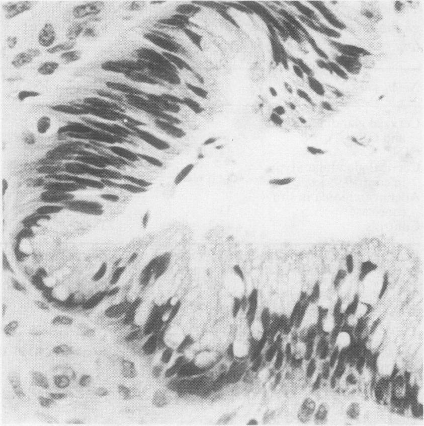Nuclei are present throughout entire epithelial thickness. x 100. I. Brown, Wells Fig. 3 Gland exhibiting high grade cervical glandular atypia with intraluminal tufting.
