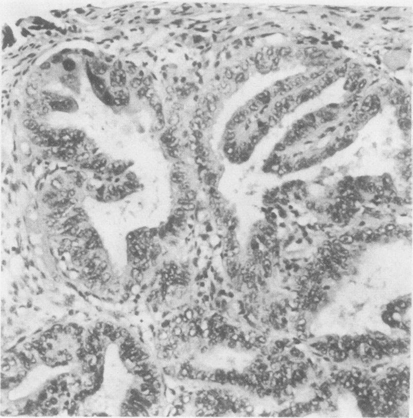 The amount of atypical epithelium varied from a small focus within an otherwise normal gland to many glands lined wholly by atypical epithelium.
