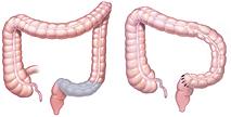 Type of Surgery Do You Need? -There are two main types of sigmoidectomy procedures: Primary bowel resection The sigmoid colon is removed and then the healthy segments are connected.