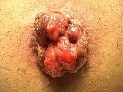 Picture A Figure 10A Mixed Hemorrhoids Picture A is an example of mixed hemorrhoids where the internal component is prolapsing (Internal hemorrhoid with mucosa=blue arrow, external component with