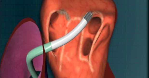 Endocardial Ablation Catheter