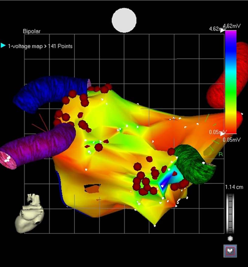 Procedure Mapping Comprehensive Biatrial Pattern with Post PVI Clamping