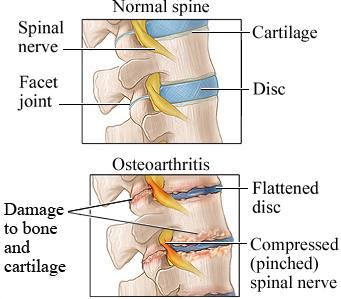 WHAT S OSTEOARTHRITIS AND HOW CAN I MANAGE IT? What Osteoarthritis (OA)?