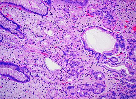 hyperplasia forming carcinoid tumour in Autoimmune gastritis) -Gastrointestinal stromal tumor, GIST(2%) ; A mesenchymal tumor that arises from Cells of Cajal Types of Gastric Polyps: they are