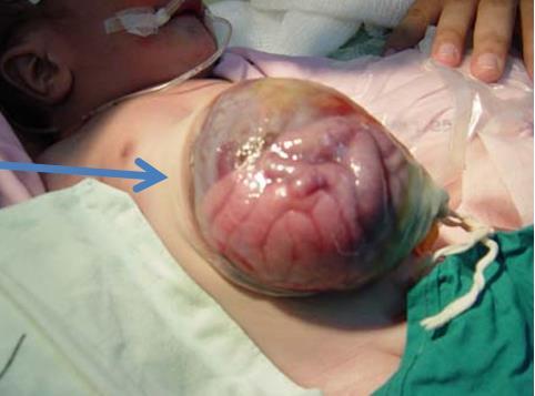 Omphalocele - Abdominal musculature fails to form (muscle wall of abdomen fails to form), leading to herniation of abdominal contents