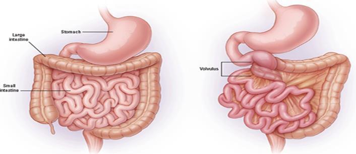 rotation of the gut.
