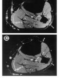Muscle & Nerve 2002;25:314-331 MRI denervation pattern STIR images of 40 yo man with acute onset fibular