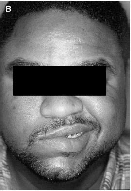 Case 3 29-year-old man presents after waking up with intense aching pain in the right jaw and ear. He has sagging of the right side of the face.