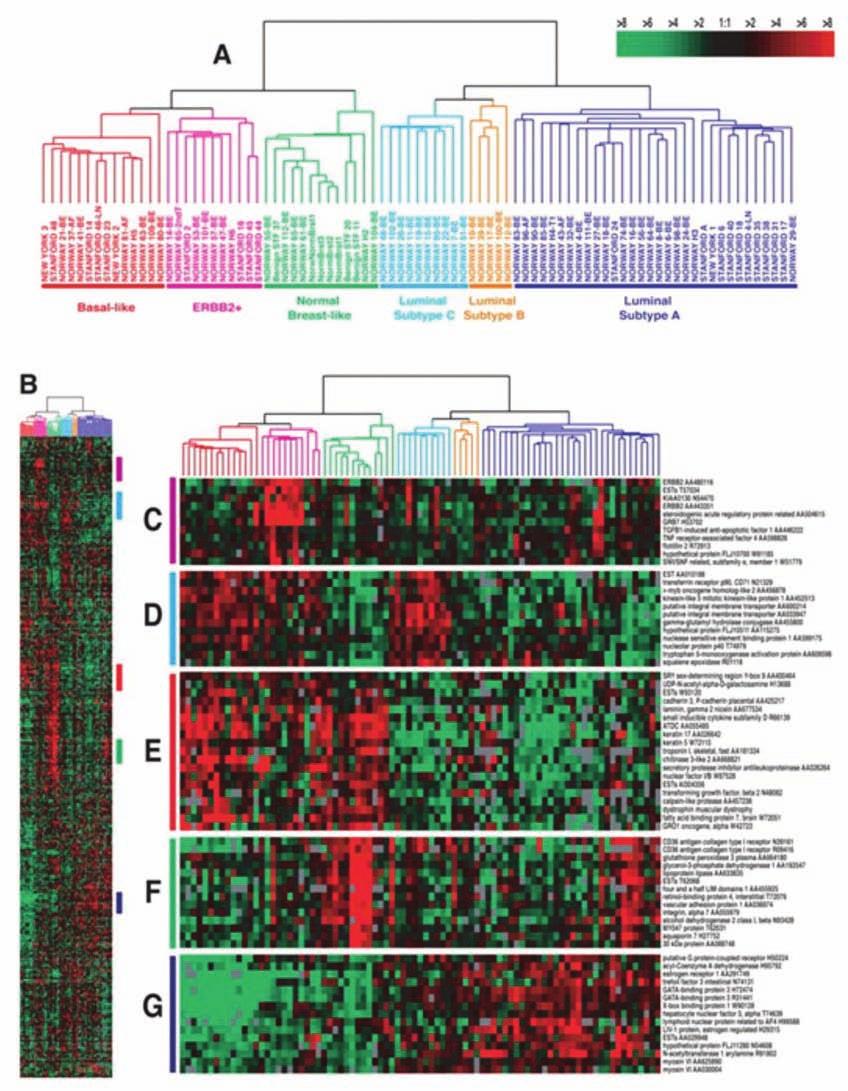 Triple-Negative Breast Cancer Biology, Metastases, and Therapy Figure 1 A B Gene Expression Patterns of 85 Experimental Breast Tissues (78 Carcinomas, 3 Benign Tumors, and 4 Normal Tissues) Analyzed
