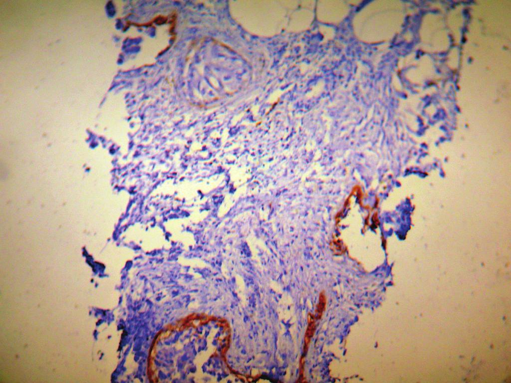 International Breast Cancer Figure 2: Nonneoplastic myoepithelial cells, whenever present, were used as built-in positive control. Figure 4: CD0 stromal staining.