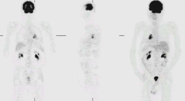 Figure 2.- PET-FDG scan for re-staging.