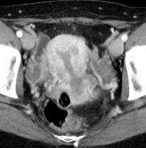 corpus luteum cyst correlative CT PET false positive Pre-operative MRI Tumor