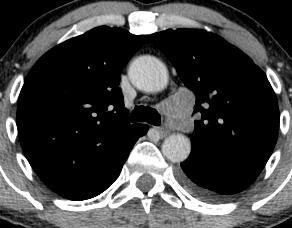 PET-CT or EBUS TBNA or EUS FNA if intermediate probability (nodes