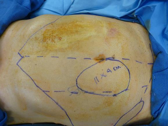 Figure 7: Prepping and draping The abdomen is prepped and draped in a standard sterile fashion from just above the xiphoid, laterally along the midaxillary line and inferiorly along the inguinal