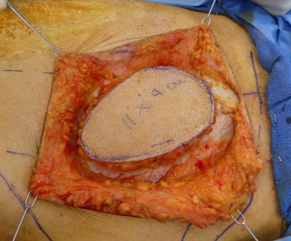 Skin paddle Design the flap only after resecting the tumour and inspecting the defect Draw the skin paddle (Figure 8) o Perforators supply a large area of skin via the subdermal plexus o Generally,