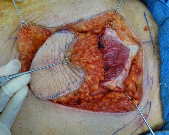 Using careful blunt dissection medial to the linea semilunaris in a lateral-tomedial fashion, the surgeon can often identify the first set of perforators (This step is not essential) Incise the