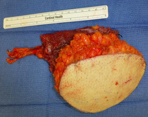 Preparing to suture the cut edges of the rectus sheath Figure 14: Inferior epigastric