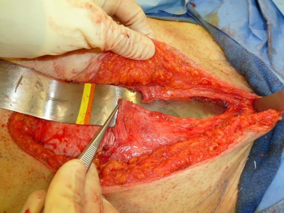 Figure 15: Rectus flap with its vascular pedicle Although the posterior rectus sheath