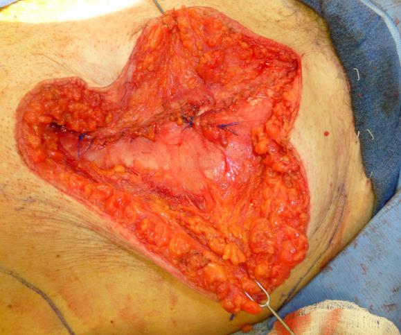 rectus sheath at the level of flap are also reapproximated with nonabsor-bable