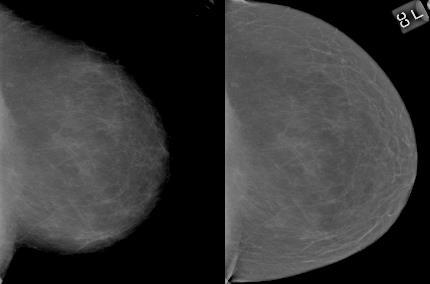 Digital Image Formation Goal: Algorithm: Thickness Compensation To visualize the entire breast with a single window setting. 1.
