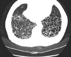 Subpleural predominant reticulation favoring the lower lung fields, Paucity of ground glass, and