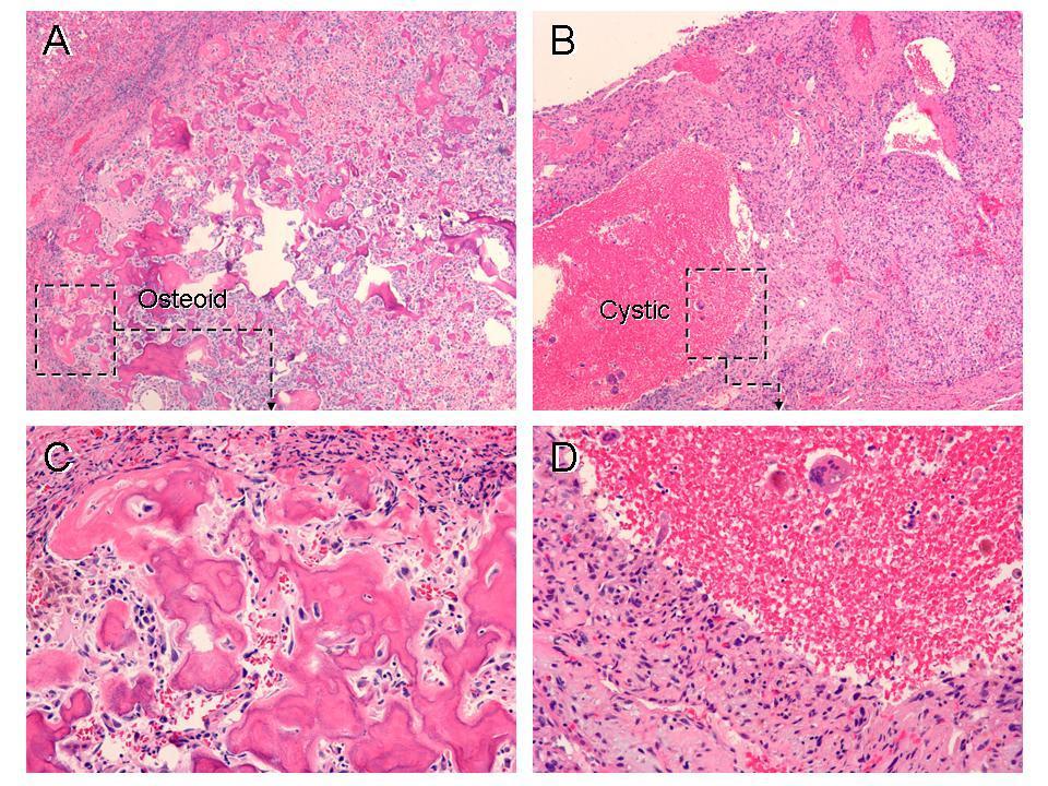 A Case of Surgical Remission in Chemo-Resistant Osteosarcoma Rexin-G plus Surgery: A Lasting Remission Rexin-G Treatment Halts Progression of the Metastatic Disease Surgical excision of