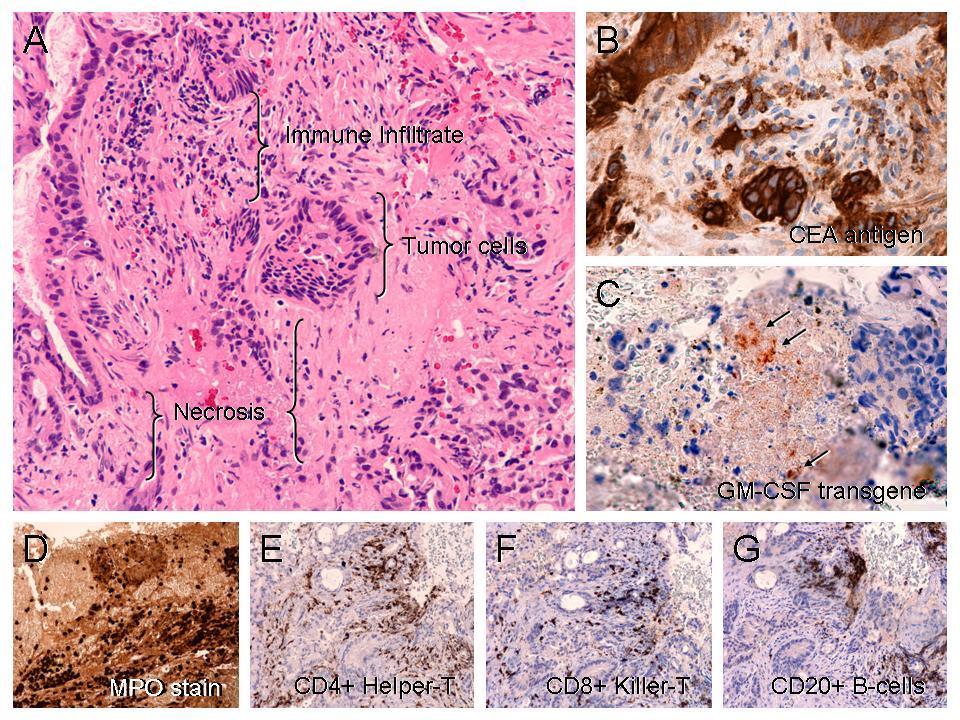 The GeneVieve Protocol: Mech-of-Action Histology and Transgene Expression in a Residual Tumor from a Colon Cancer Patient after Infusions of Reximmune-C Immune Infiltration Following Reximmune-C The