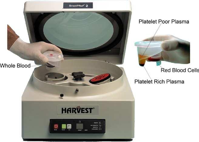 228 Nguyen et al APPLICATIONS OF PLATELET-RICH PLASMA IN MUSCULOSKELETAL AND SPORTS MEDICINE Figure 1. Platelet Concentrate System. Photo courtesy of Harvest Technologies, SmartPReP.