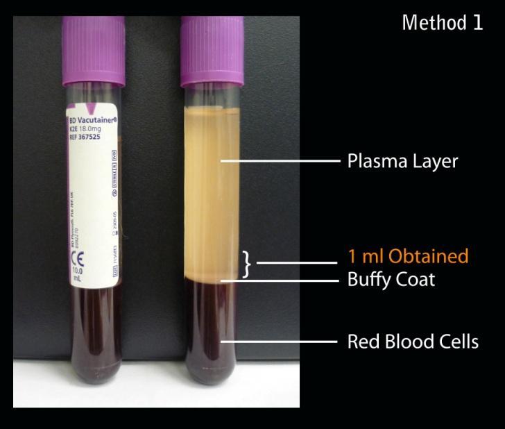 ORIGINAL ARTICLE JUMMEC 211: 14(2) It is found that the mean number of platelet counts for obtained by following method 2 produces the highest platelet count (Kruskall-wallis: p<.5).