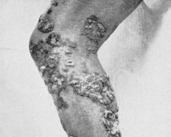 Chromoblastomycosis A chronic, localized infection of subcutaneous tissues Verrucous nodules (cauliflowerlike appearance) Caused by several species of dematiaceous