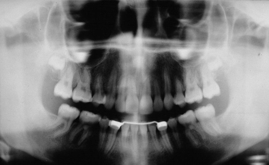 If an implant is used to move adjacent teeth and close an edentulous space, the timing of implant loading is an important factor.