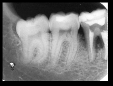 The purpose of this study was to report a successful autotransplantation case of a mature third mandibular molar.