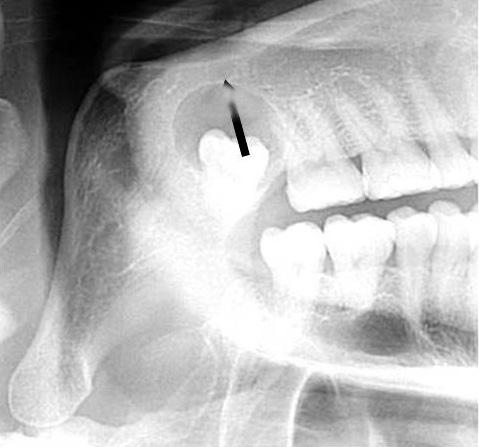 Radiographic characteristics of the mandibular cystic lesion involving the third molar was measured assuming normal posterior tooth