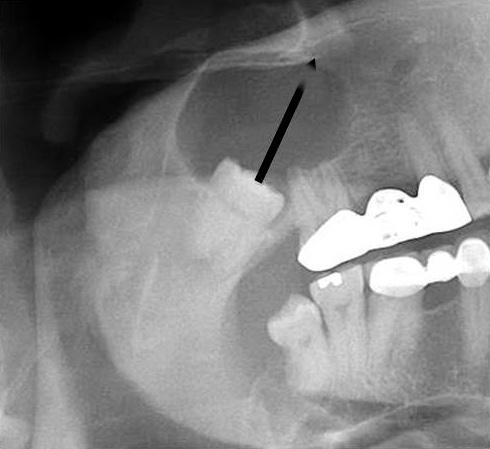 When the center of the third molar deviated from the arch curvature, the displacement of the third molar was categorized as buccal