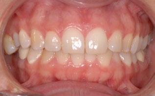 right molar region before treatment.