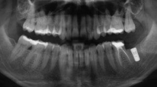 of an overerupted upper left second molar.
