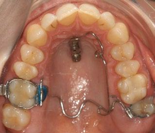 restoration placed on dental implant. Fig.