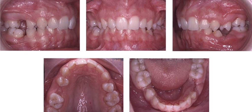 The persistent mandibular left second deciduous molar appeared in infraocclusion, with a horizontal interdental crestal bone level and no root resorption.