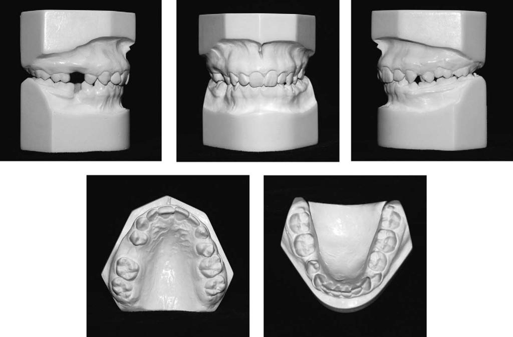 636 Sabri American Journal of Orthodontics and Dentofacial Orthopedics May 2004 Fig 3. Pretreatment dental casts. Fig 4. Pretreatment panoramic radiograph. Fig 5. Pretreatment cephalometric tracing.