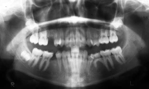 Maxillary and mandibular incisors were to be intruded and proclined to an optimal overbite-overjet relationship. The gingival smile was to be reduced.