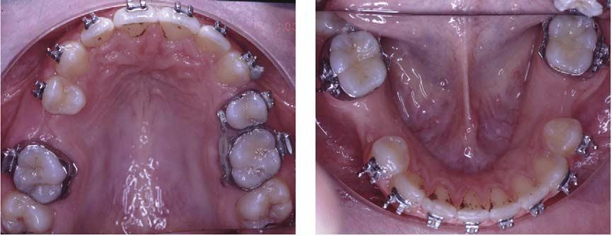 638 Sabri American Journal of Orthodontics and Dentofacial Orthopedics May 2004 Fig 6. Preimplant occlusal photographs. Fig 7. Preimplant panoramic radiograph.