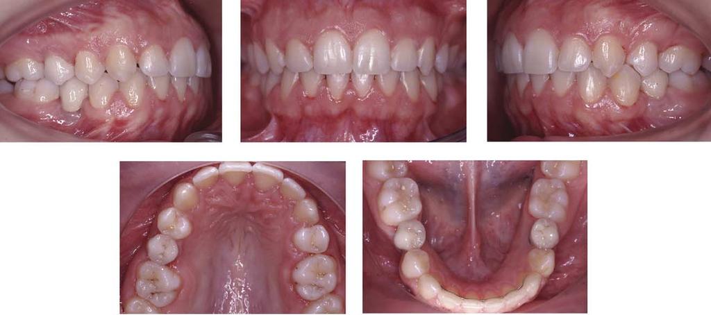 DISCUSSION The 2 treatment options commonly used with congenitally missing second premolars are space opening for future restorations or space closure so that natural teeth touch each other.