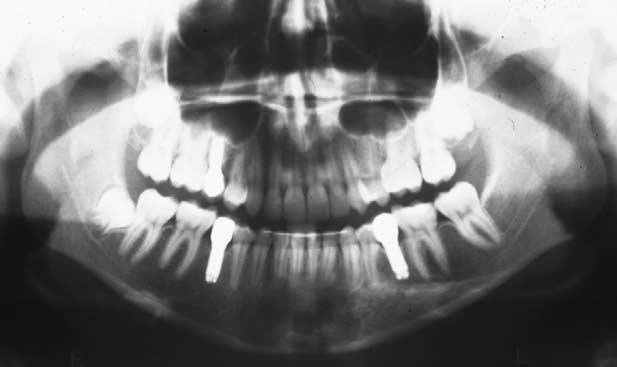 640 Sabri American Journal of Orthodontics and Dentofacial Orthopedics May 2004 Fig 11. Posttreatment dental casts. Fig 12. Posttreatment panoramic radiograph.