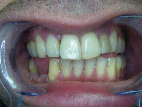 The malocclusion thus installed may increase the para-functional vicious habits such as contraction of the raising muscles, and teeth