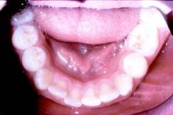 molars Class I