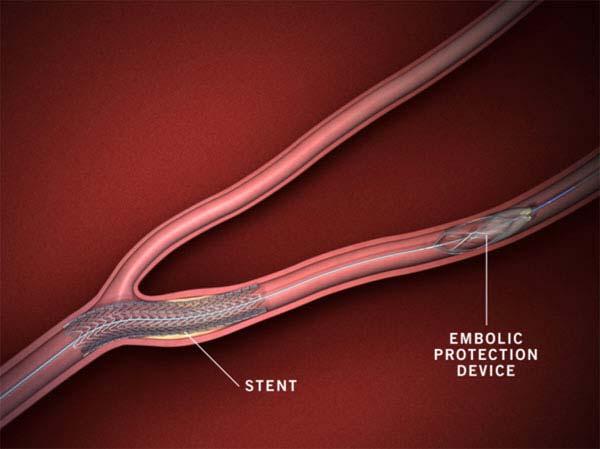 Carotid Stenting vs CEA Up to 2 / 4 years FU shows similirar rates of ischemic stroke between Carotid Stenting and CEA after the 30 days outcomes Endarterectomy Versus Angioplasty in Patients with