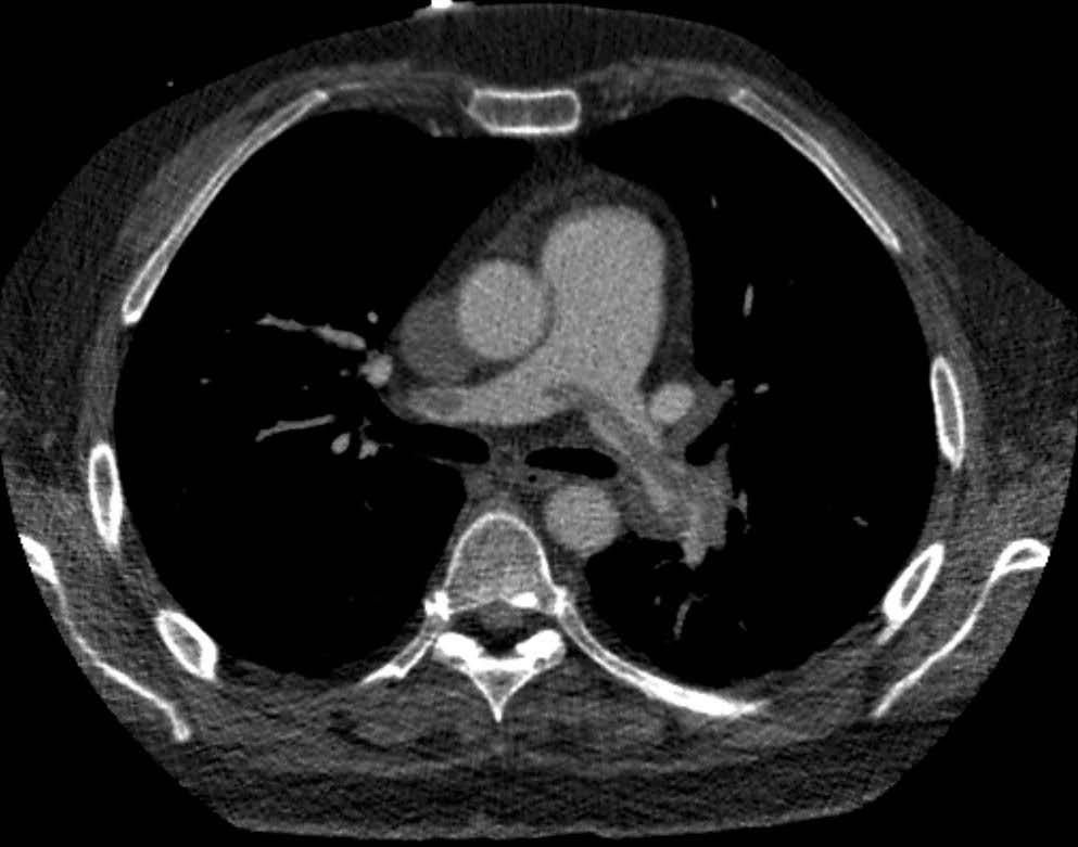 Update on diagnostic techniques of PE 23 Figure 2. Computed tomography pulmonary angiography (CTPA) of patient with saddle embolus. Large central pulmonary emboli are well recognizable by CTPA.