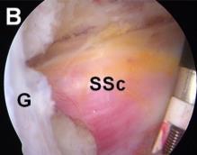Sliding) procedure Ando, Sugaya, et al, Arthroscopy, 2012 AS RATS Procedure Arthroscopic RATS!! 1. Remove scar tissue @ RI 2. Resume transverse sliding of the SSC 3.