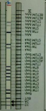 Figure.5 Mycobacterium tuberculosis, MDR-TB (Missing rpob WT2 ; rpob WT3 and inha WT1 and presence of inha MUT1 ) Figure.