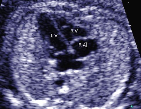 Normal orientation is called levocardia Heart size occupies one-third of the chest area